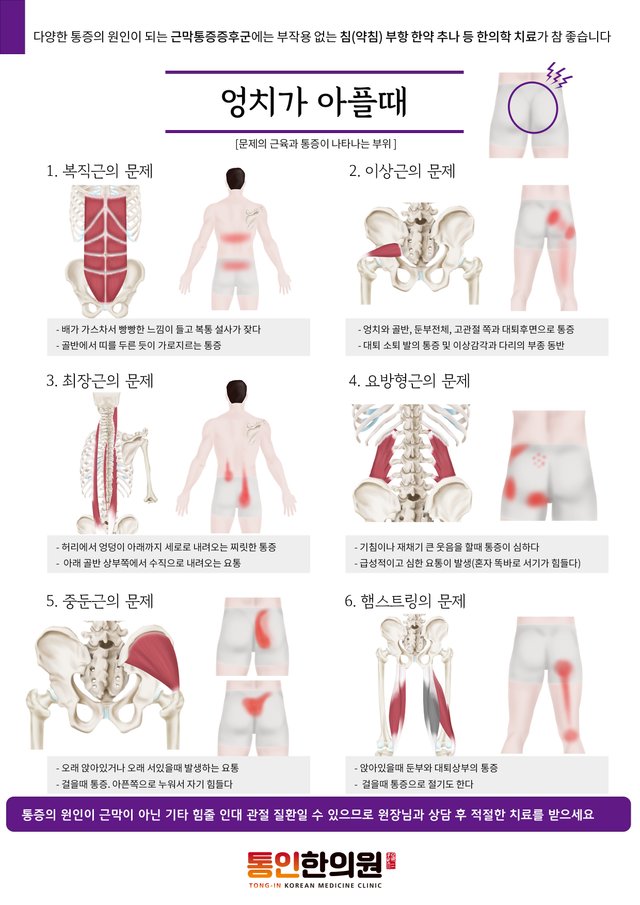 [근막통증증후군7]엉치가 아플때(a4).jpg